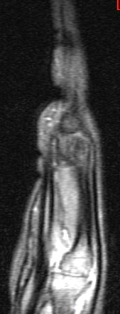 Figure 5 for case Juvenile idiopathic arthritis